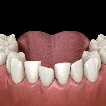 Illustration of crooked teeth