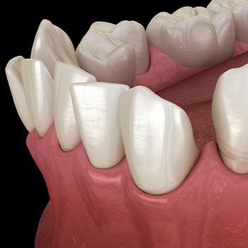 Illustration of gapped teeth