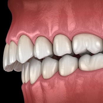 Illustration of an overbite