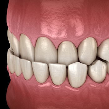 Illustration of an underbite