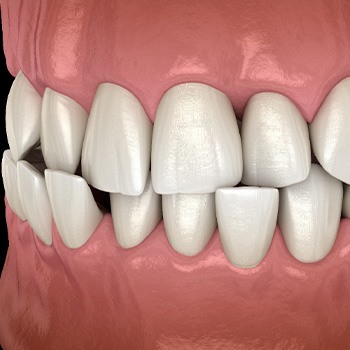 Illustration of a crossbite