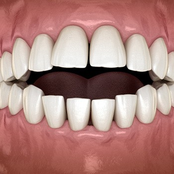 Illustration of an open bite