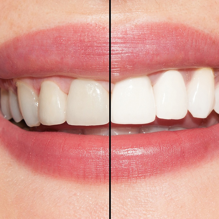 Closeup of smile before and after teeth whitening