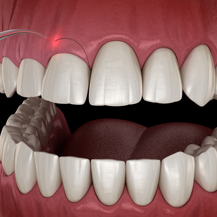 Closeup of smile after gum recontouring