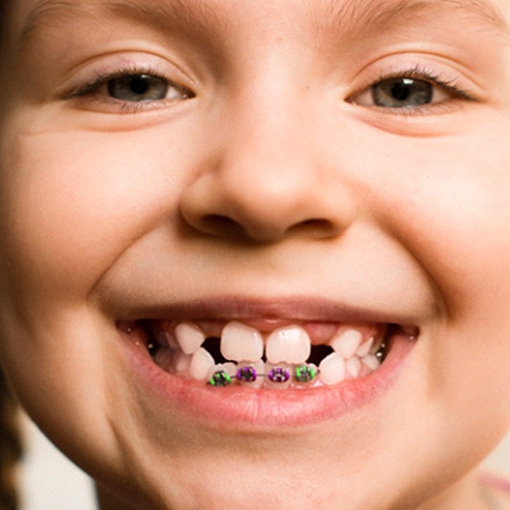 smiling girl who knows what dental sealants in Long Beach are