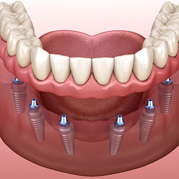 Digital illustration of implant dentures in Long Beach