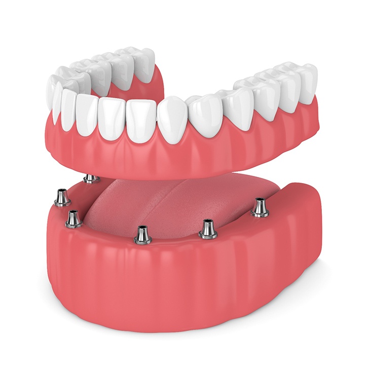 Illustration of implant dentures in Long Beach, NY
