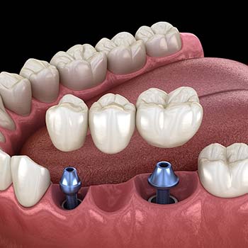 Animated dental implant supported fixed bridge placement