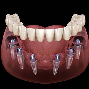 Animatd dental implant supported denture