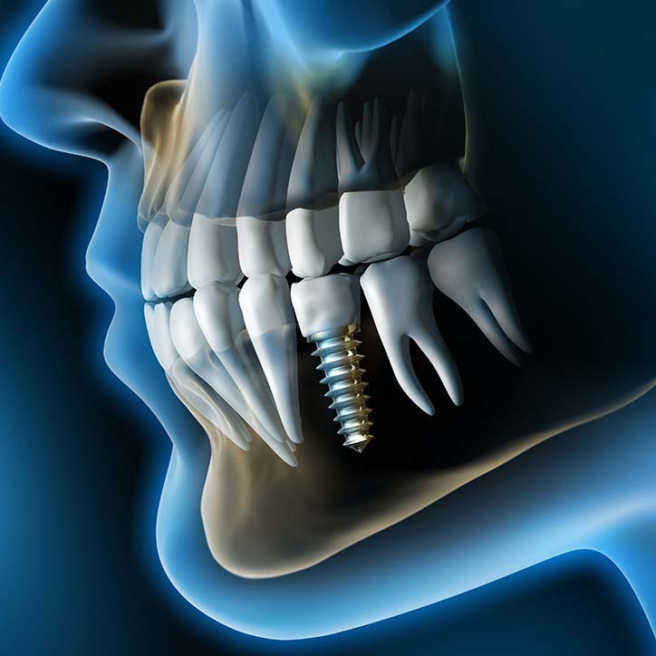 Digital illustration of X-ray showing dental implant in Long Beach