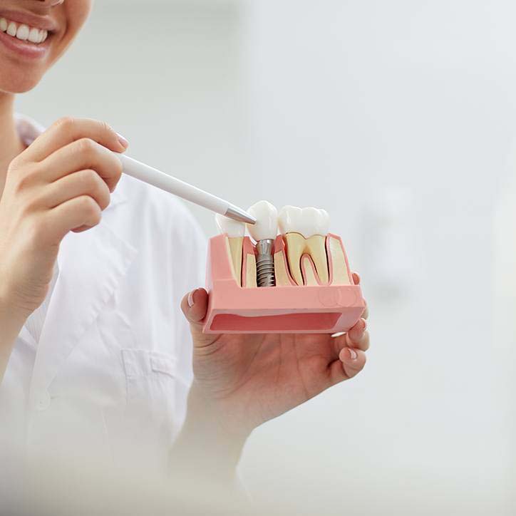 Dentist pointing to model of dental implants in Long Beach