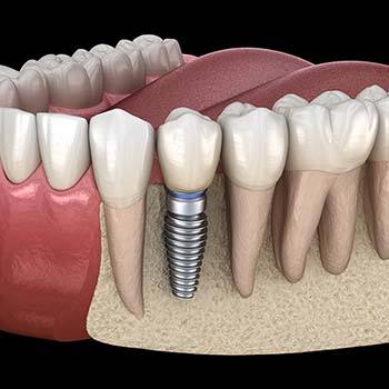 Animated dental implant supported replacement tooth in smile line