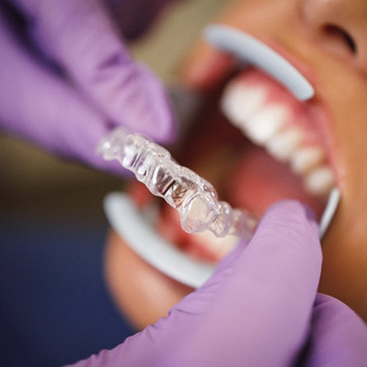 Orthodontist placing Invisalign trays on patient