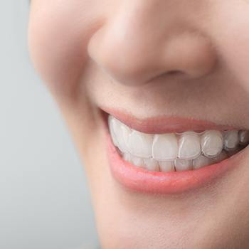 Closeup of patient wearing Invisalign aligners