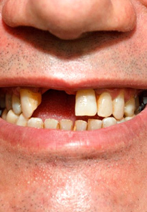 Man smiling to reveal missing teeth