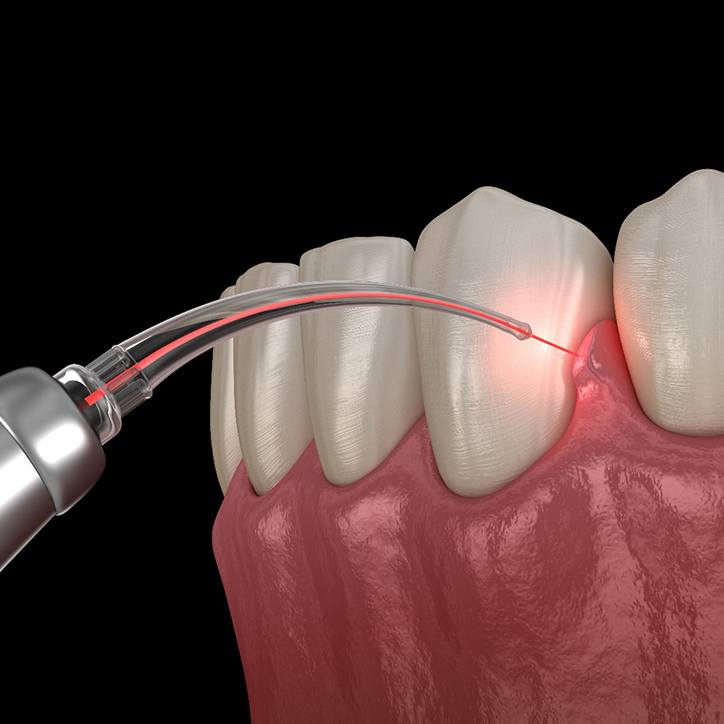 An up-close view of a person’s lips and upper teeth and a digital image of a laser beam touching their front tooth