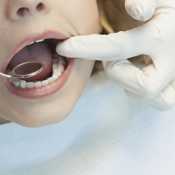 Dentist checking child's dental sealants