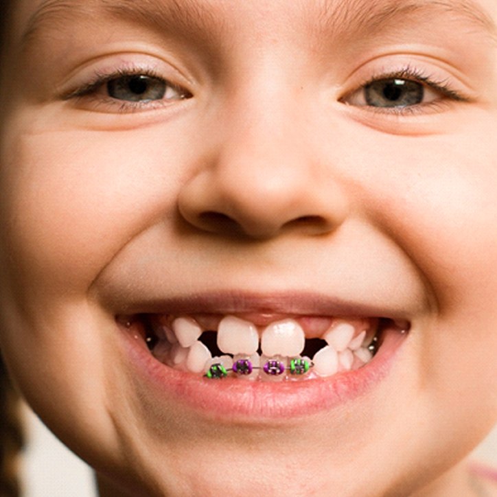 Girl with braces in Long Beach