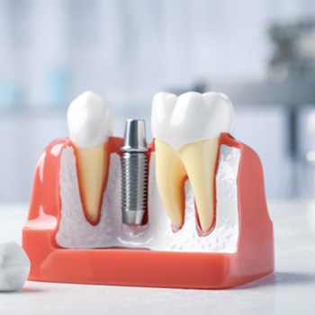 A model of a dental implant and its abutment