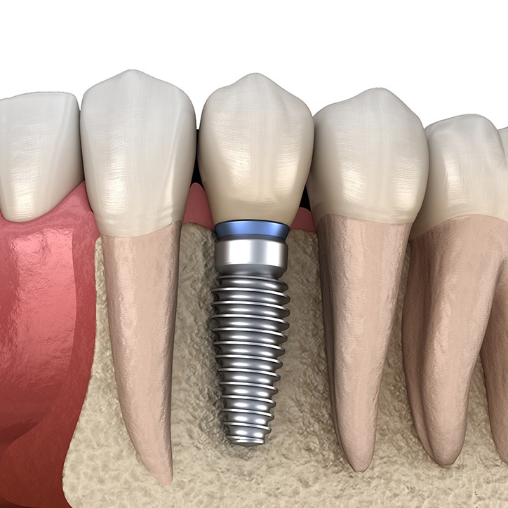 Animated dental implant supported dental crown