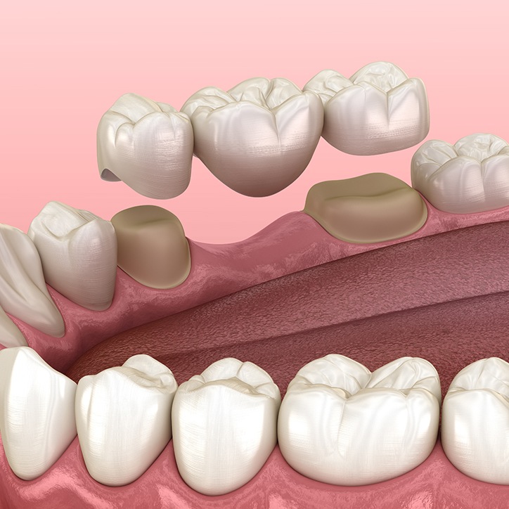 Animated dental bridge placement