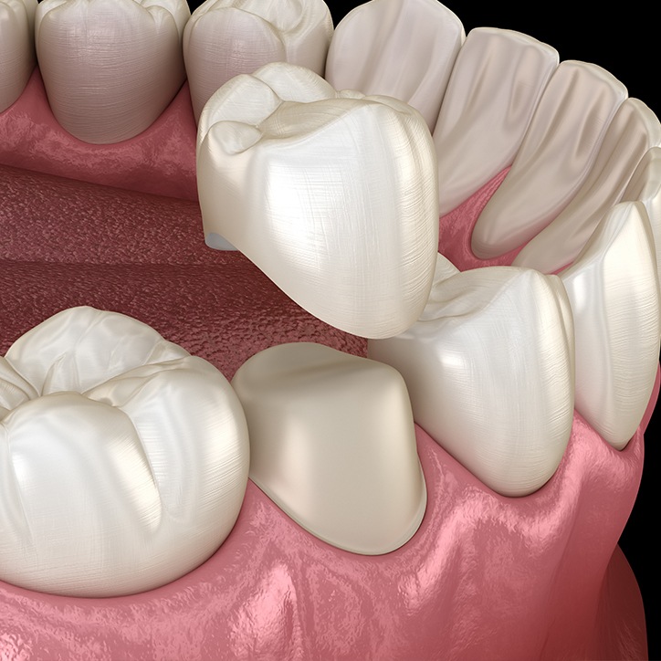Animated dental crown placement