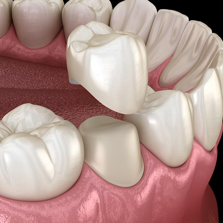 Animated dental crown placement