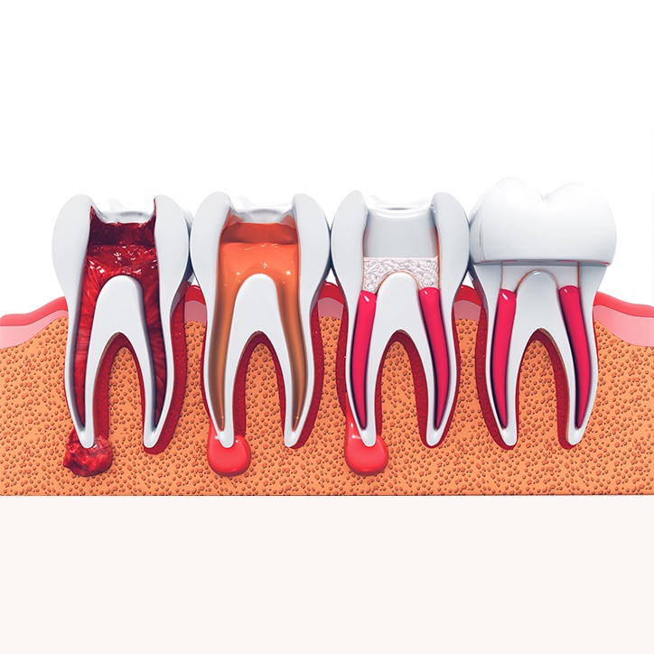 Animated root canal treatment process