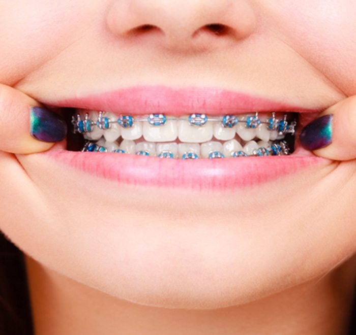 A closeup of a patient with braces in Long Beach, NY