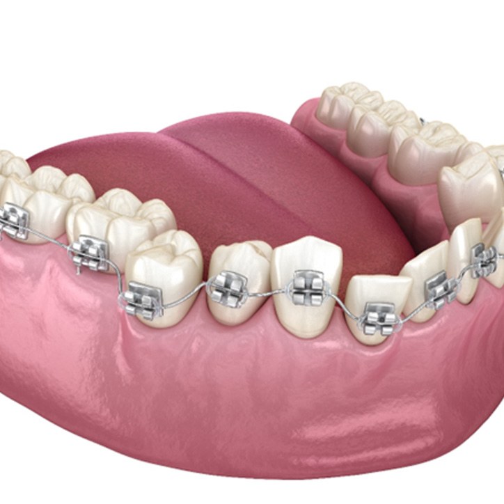 An illustration of braces being used to correct overlapping teeth in Long Beach, NY