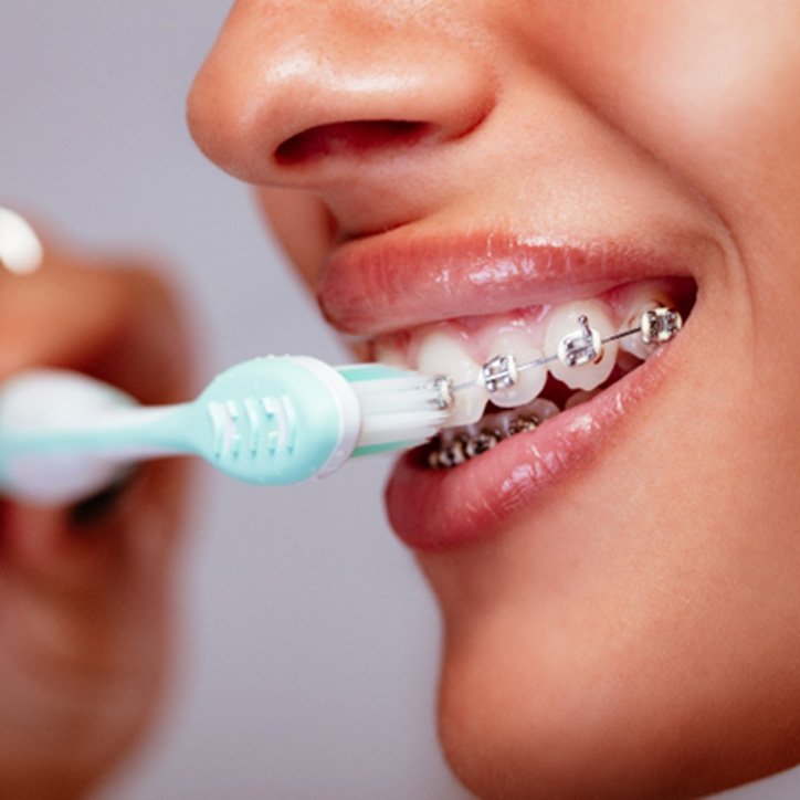 A patient brushing her teeth with braces in Long Beach, NY
