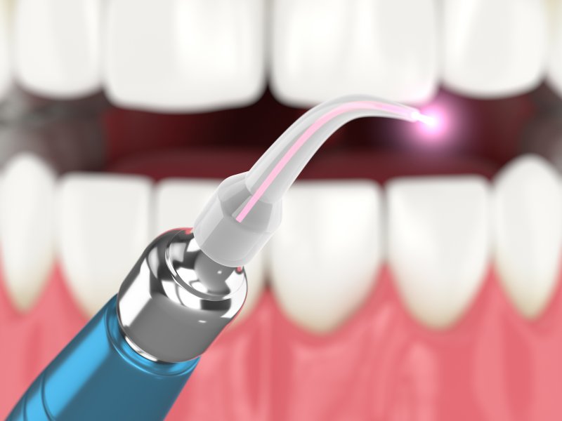 a digital image of a soft tissue dental laser being used in preparation to repair a patient’s smile
