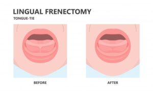 diagram of before and after tongue-tie treatment