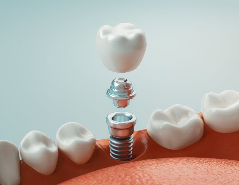 A 3D rendering of a dental implant